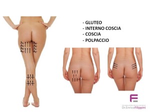 fili riassorbibili su interno coscia glutei ginocchia