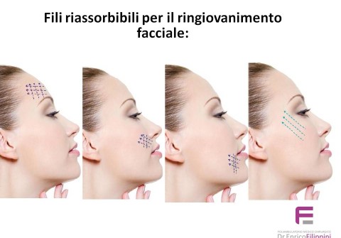zone viso trattabili con fili di ringiovanimento in pdo