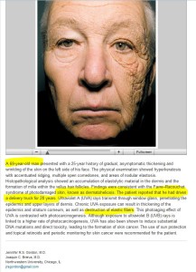 dermatoheliosis-unilateral-NEJM