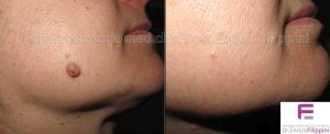 Rimozione fibroma sul viso con Plexer