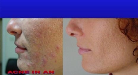 trattamenti per cicatrici acne