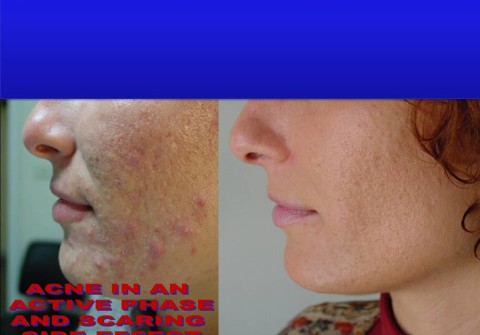 Acne e cicatrici da acne