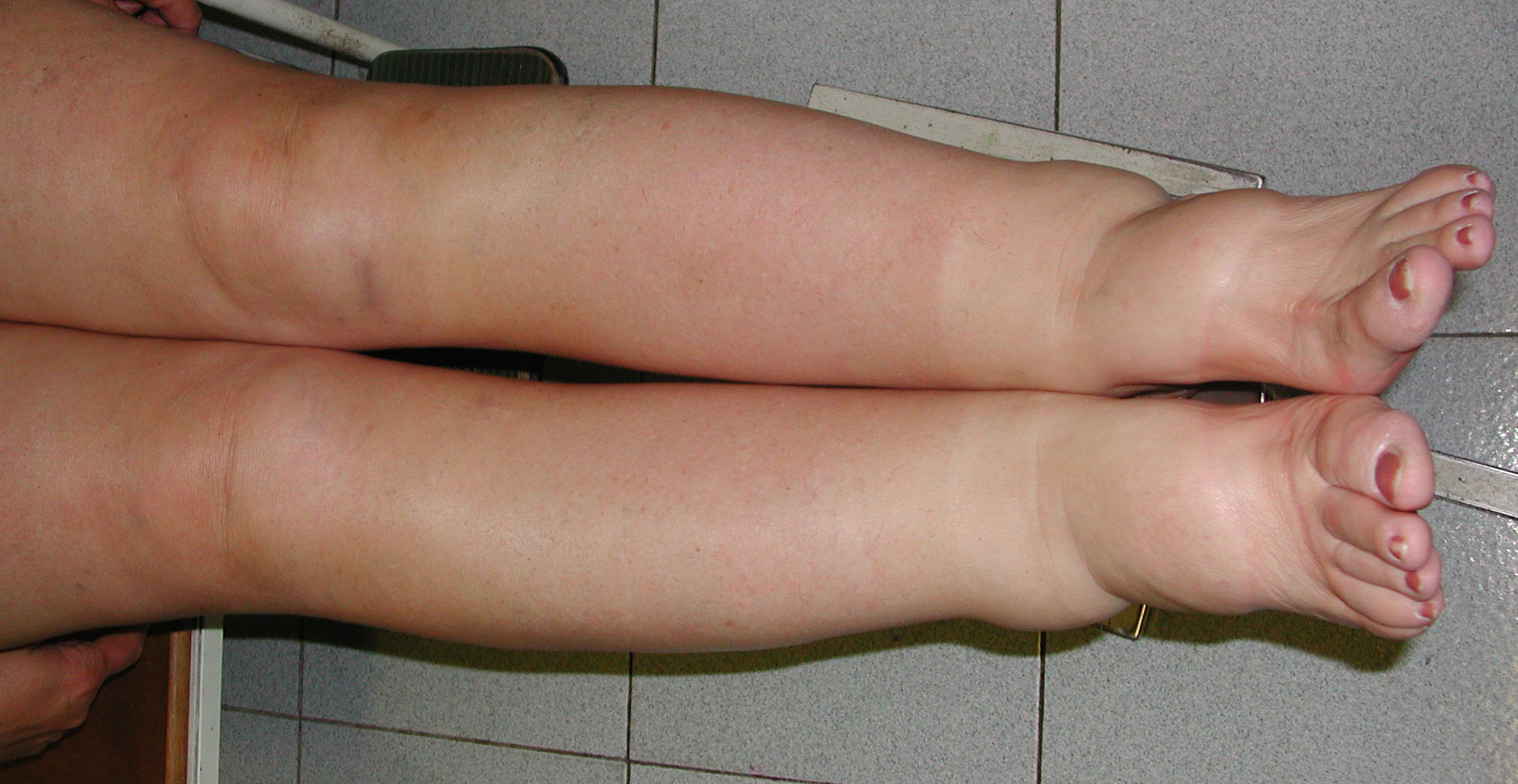 Linfedema gambe