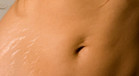 Smagliature