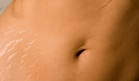 Smagliature