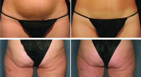 Remise en forme con Velashape 2