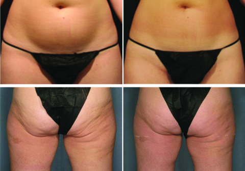 Remise en forme con Velashape 2