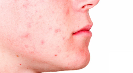 Acne in età adulta