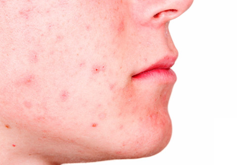 Acne in età adulta