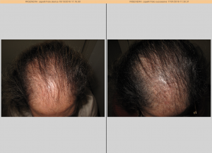 alopecia androgenetica femminile e calvizie femminili: esempi