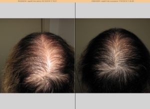 alopecia femminile:come si manifesta
