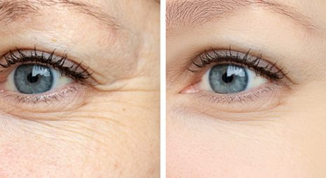 vantaggi biostimolazione contro invecchiamento della pelle