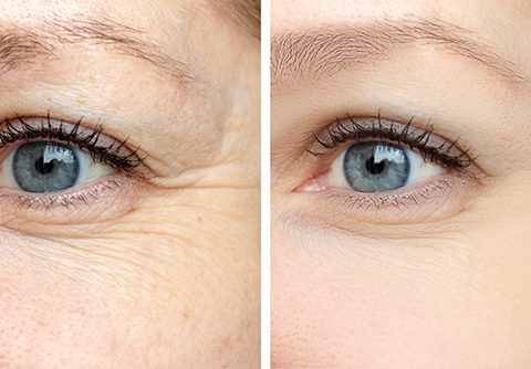 vantaggi biostimolazione contro invecchiamento della pelle