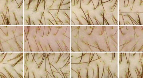 Trapianto_capelli