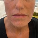 dopo-biostimolazione-viso-peptidi (1)