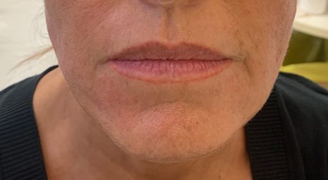 dopo-biostimolazione-viso-peptidi (1)