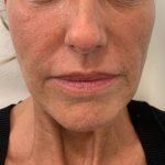 prima-biostimolazione-viso (1)