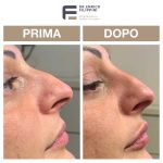 rinofiller-naso-prima e dopo