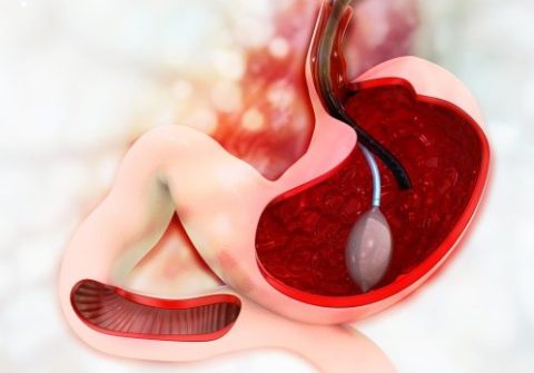 palloncino intragastrico-sezione stomaco