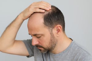 curare_alopecia_brescia