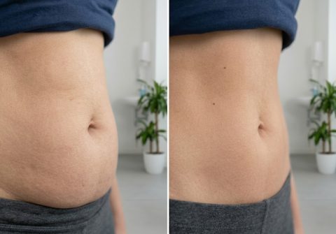 intralipoterapia-soluzione-grasso-localizzato