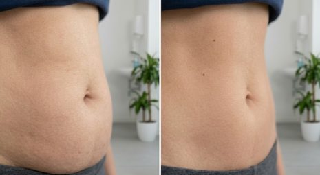 intralipoterapia-soluzione-mirata-grasso-localizzato